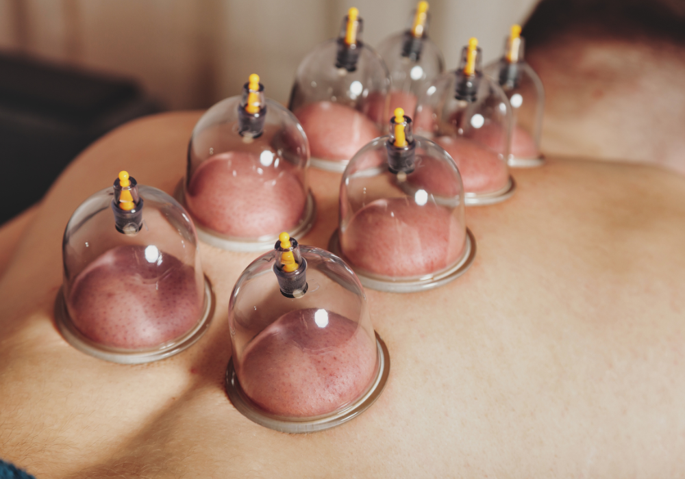 Schröpftherapie.